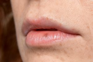 bibir pecah-pecah