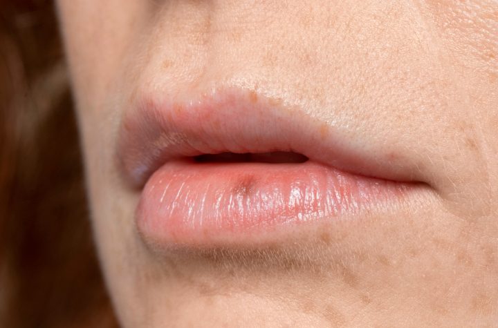 bibir pecah-pecah
